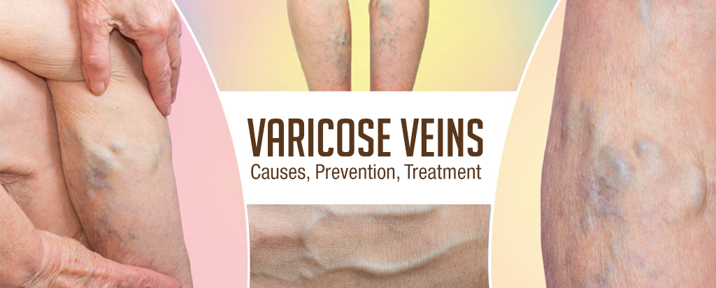 Varicose veins, causes, treatment, prevention